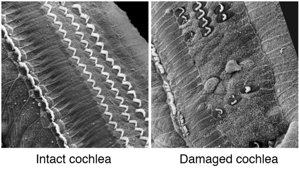 Intact cochlea vs Damaged cochlea